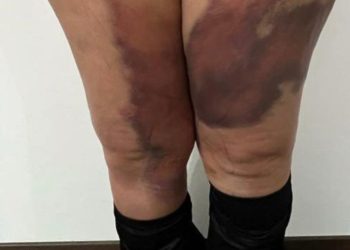 Yağ aldırma operasyonuna dava: Vücudundaki morluklar geçmedi